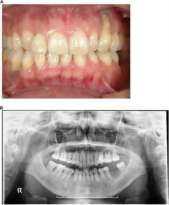 Mouse Model of Loeys–Dietz Syndrome Shows Elevated Susceptibility to Periodontitis via Alterations in Transforming Growth Factor-Beta Signaling